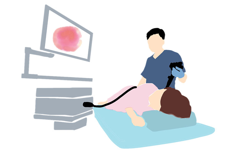 大腸カメラのイメージイラスト