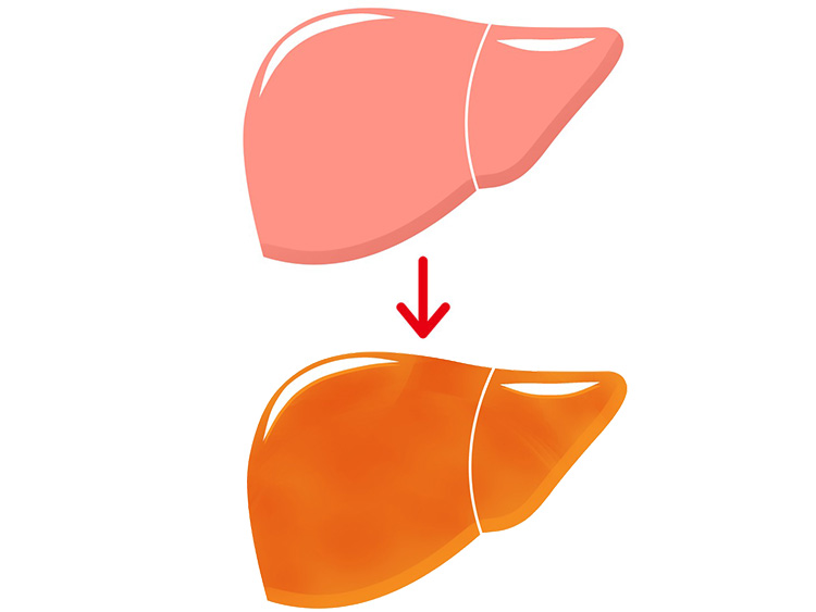 脂肪性肝疾患のイメージ写真