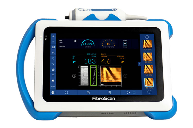 フィブロスキャン